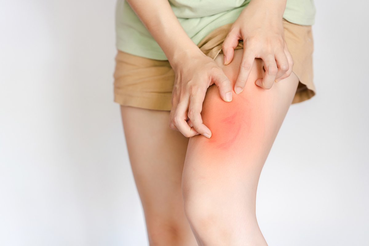 Women have some allergic reactions and itching in the thighs.